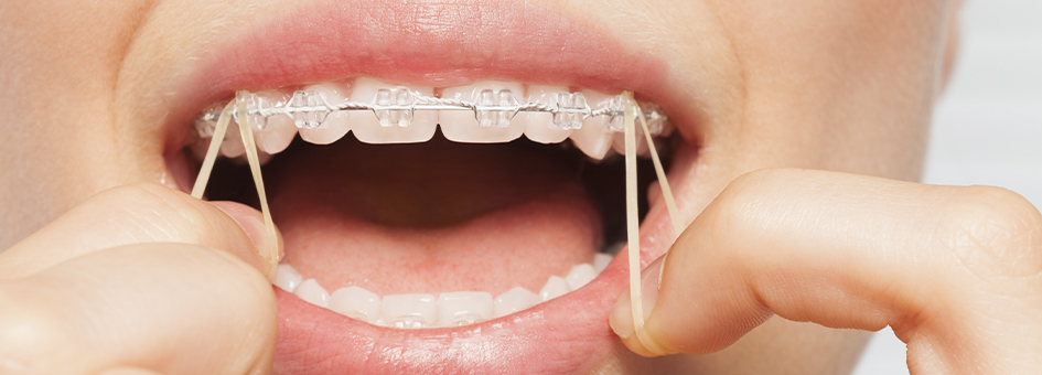 Зачем резинки на брекетах: для чего нужны резиночки для брекетов на зубы